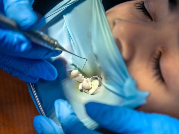 Por que a resina Filtek, da Solventum, é referência entre profissionais da odontologia?