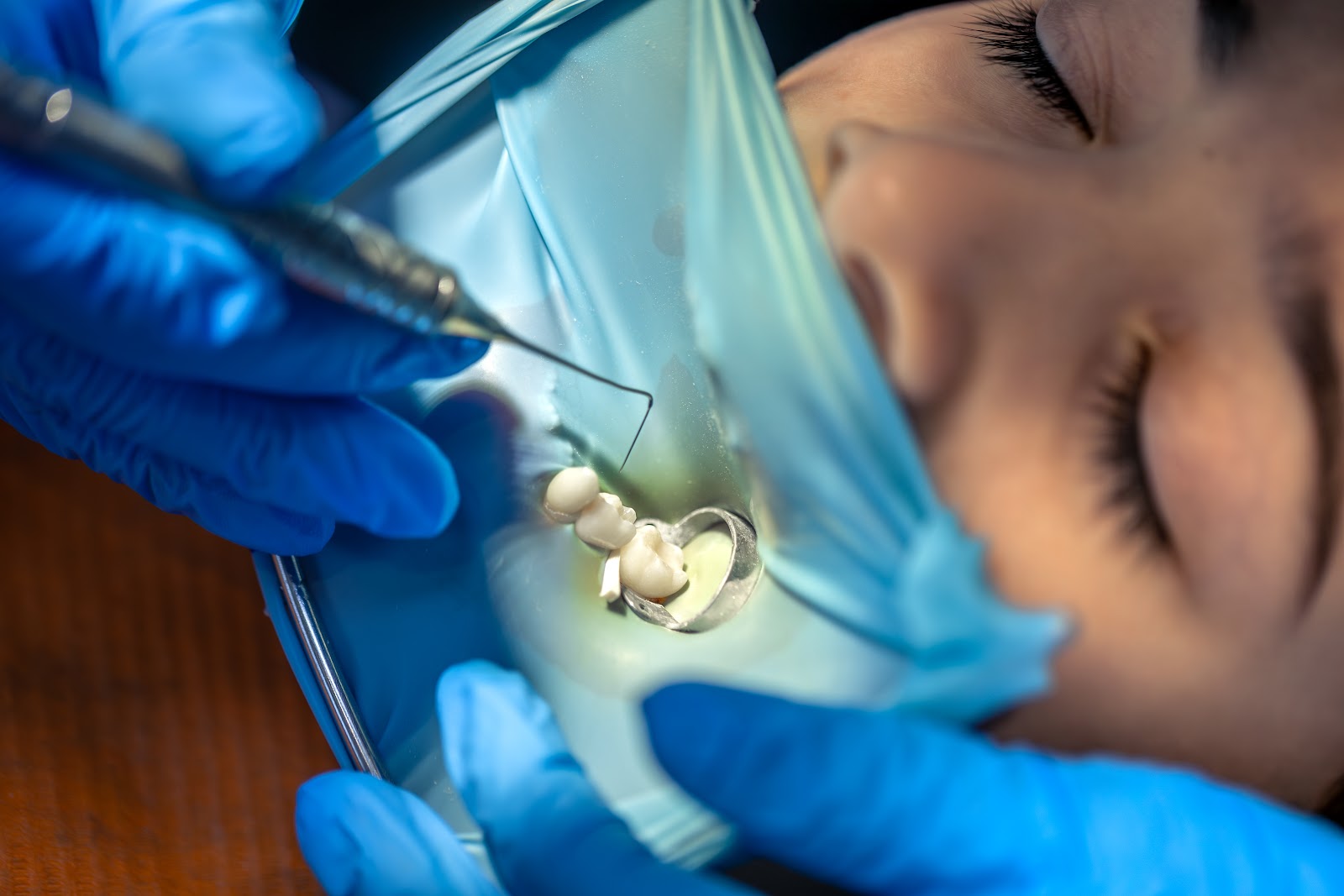 Por que a resina Filtek, da Solventum, é referência entre profissionais da odontologia?