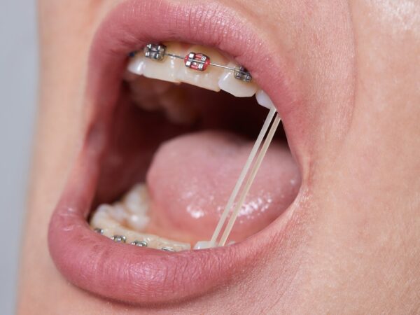 Como selecionar materiais para ortodontia: do elástico intraoral ao colocador de elástico Morelli