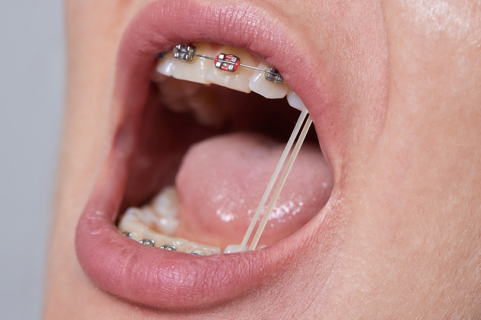 Como selecionar materiais para ortodontia: do elástico intraoral ao colocador de elástico Morelli